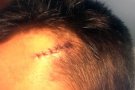 Un jugador del CF Canonja acaba amb punts al cap per una agressió davant l'EF Pastoreta